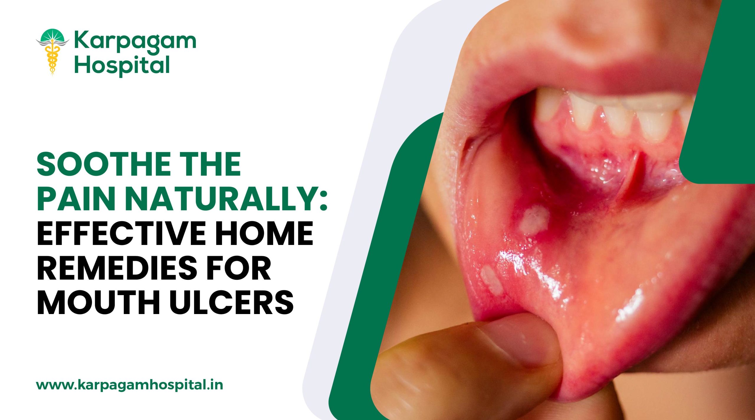 Home Remedies for Mouth Ulcers